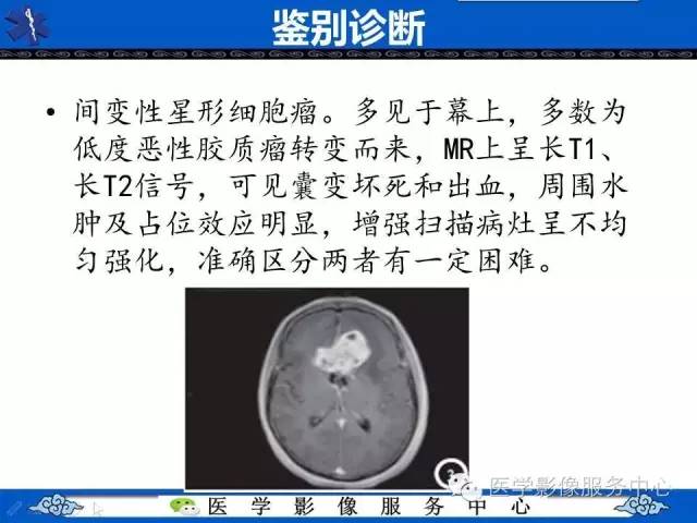 【病例】左额叶胶质肉瘤1例MR影像表现