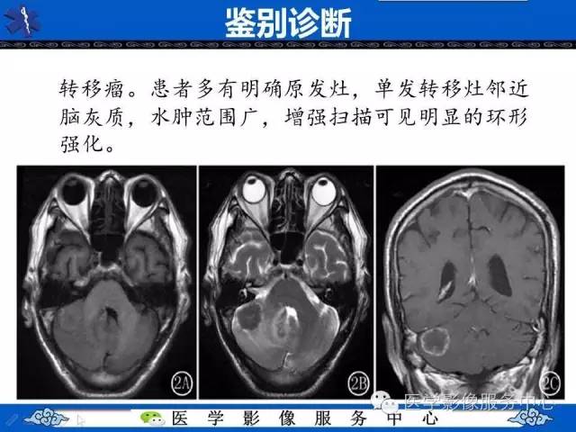 【病例】左额叶胶质肉瘤1例MR影像表现