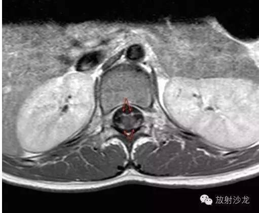 格林-巴利综合征的典型表现及影像学特征 格林-巴利综合征的典型表现及影像学特征
