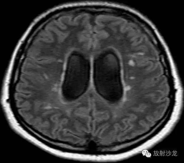 格林-巴利综合征的典型表现及影像学特征 格林-巴利综合征的典型表现及影像学特征
