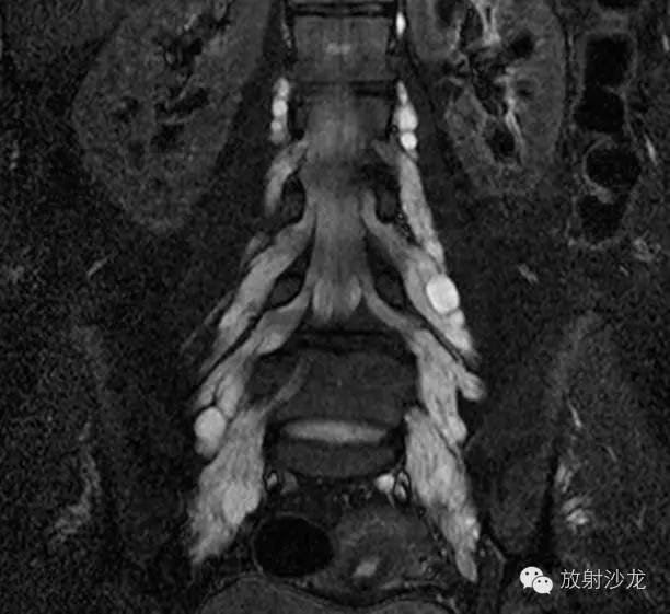 格林-巴利综合征的典型表现及影像学特征 格林-巴利综合征的典型表现及影像学特征