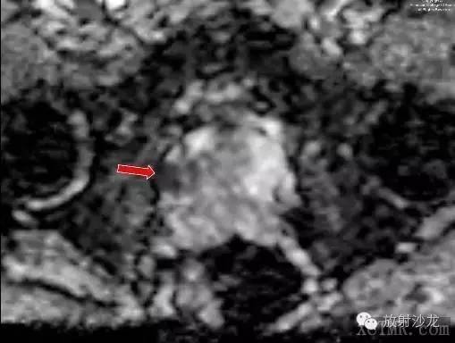 【病例】前列腺腺癌1例MRI影像诊断要点