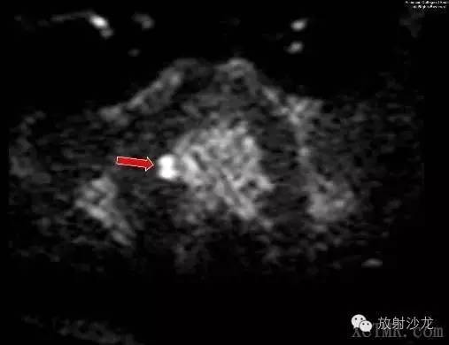 【病例】前列腺腺癌1例MRI影像诊断要点 【病例】前列腺腺癌1例MRI影像诊断要点