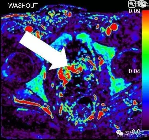 【病例】前列腺腺癌1例MRI影像诊断要点 【病例】前列腺腺癌1例MRI影像诊断要点