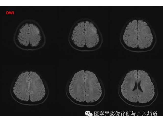 【病例】左额叶胶质细胞瘤1例MR影像表现 【病例】左额叶胶质细胞瘤1例MR影像表现