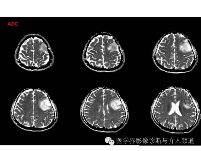 【病例】左额叶胶质细胞瘤1例MR影像表现 【病例】左额叶胶质细胞瘤1例MR影像表现