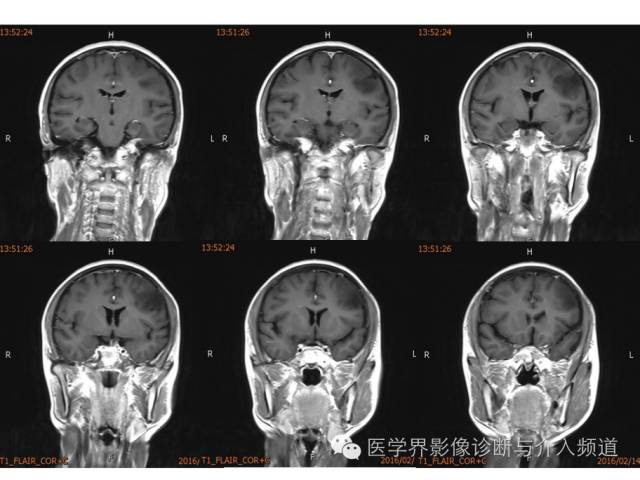 【病例】左额叶胶质细胞瘤1例MR影像表现 【病例】左额叶胶质细胞瘤1例MR影像表现