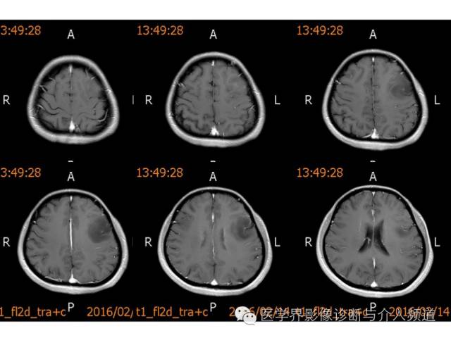 【病例】左额叶胶质细胞瘤1例MR影像表现 【病例】左额叶胶质细胞瘤1例MR影像表现