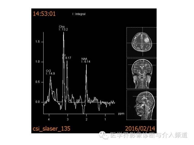 【病例】左额叶胶质细胞瘤1例MR影像表现 【病例】左额叶胶质细胞瘤1例MR影像表现