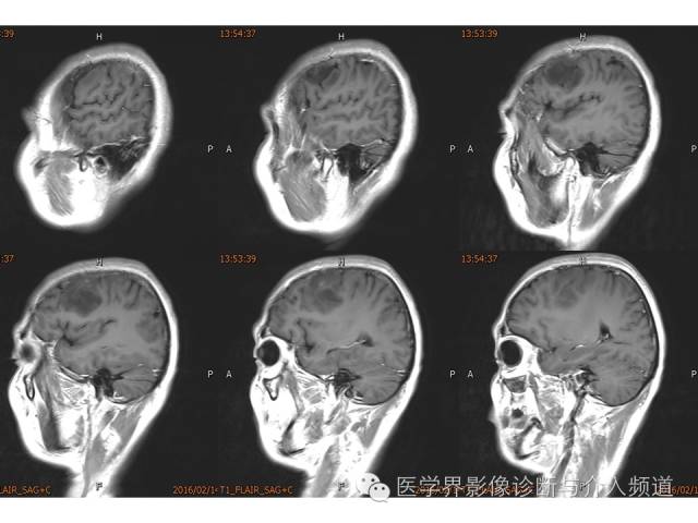 【病例】左额叶胶质细胞瘤1例MR影像表现 【病例】左额叶胶质细胞瘤1例MR影像表现