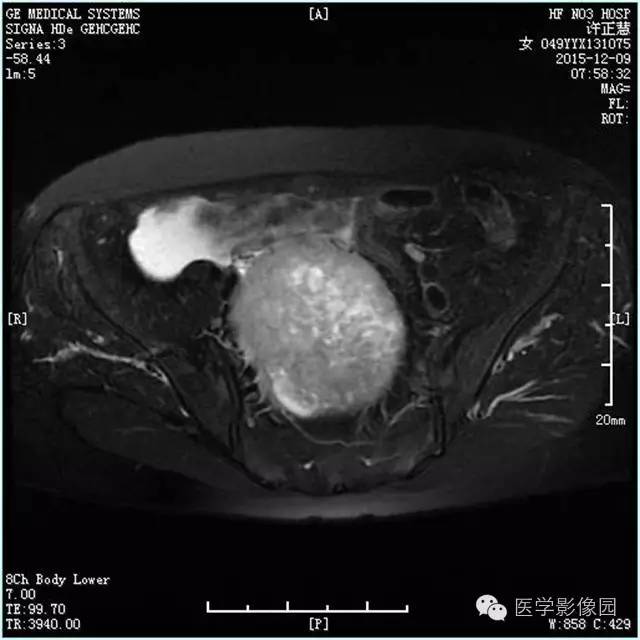 【病例】卵巢卵泡膜细胞瘤1例MR影像表现 【病例】卵巢卵泡膜细胞瘤1例MR影像表现