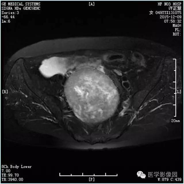 【病例】卵巢卵泡膜细胞瘤1例MR影像表现 【病例】卵巢卵泡膜细胞瘤1例MR影像表现