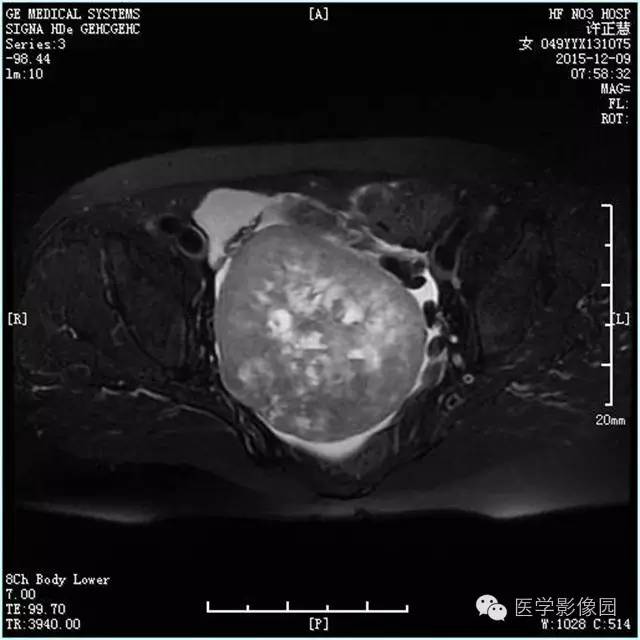 【病例】卵巢卵泡膜细胞瘤1例MR影像表现 【病例】卵巢卵泡膜细胞瘤1例MR影像表现