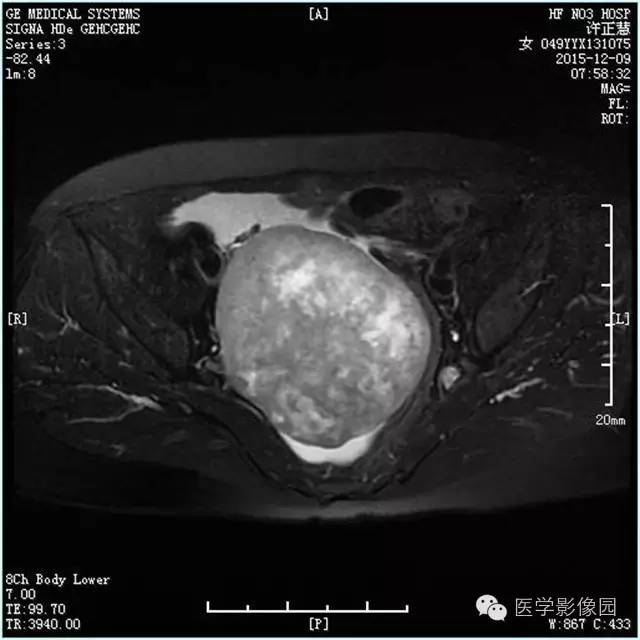 【病例】卵巢卵泡膜细胞瘤1例MR影像表现 【病例】卵巢卵泡膜细胞瘤1例MR影像表现