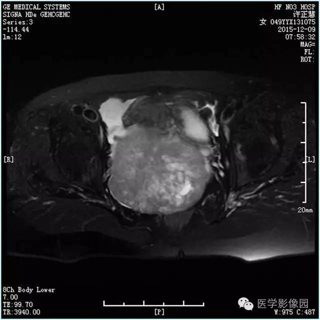 【病例】卵巢卵泡膜细胞瘤1例MR影像表现 【病例】卵巢卵泡膜细胞瘤1例MR影像表现