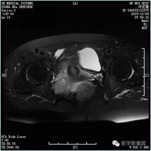 【病例】卵巢卵泡膜细胞瘤1例MR影像表现 【病例】卵巢卵泡膜细胞瘤1例MR影像表现