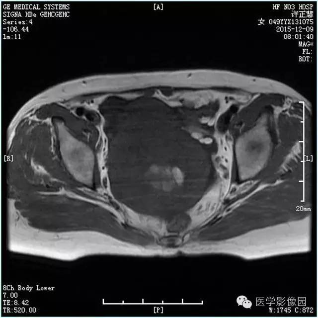 【病例】卵巢卵泡膜细胞瘤1例MR影像表现 【病例】卵巢卵泡膜细胞瘤1例MR影像表现