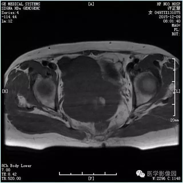 【病例】卵巢卵泡膜细胞瘤1例MR影像表现 【病例】卵巢卵泡膜细胞瘤1例MR影像表现