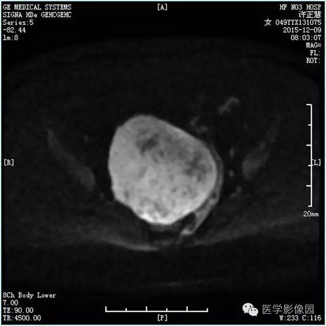 【病例】卵巢卵泡膜细胞瘤1例MR影像表现 【病例】卵巢卵泡膜细胞瘤1例MR影像表现