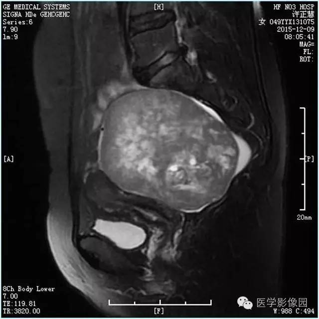 【病例】卵巢卵泡膜细胞瘤1例MR影像表现 【病例】卵巢卵泡膜细胞瘤1例MR影像表现