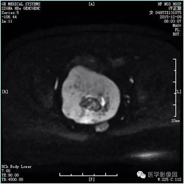 【病例】卵巢卵泡膜细胞瘤1例MR影像表现 【病例】卵巢卵泡膜细胞瘤1例MR影像表现