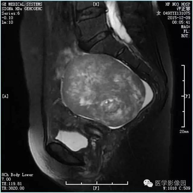 【病例】卵巢卵泡膜细胞瘤1例MR影像表现 【病例】卵巢卵泡膜细胞瘤1例MR影像表现