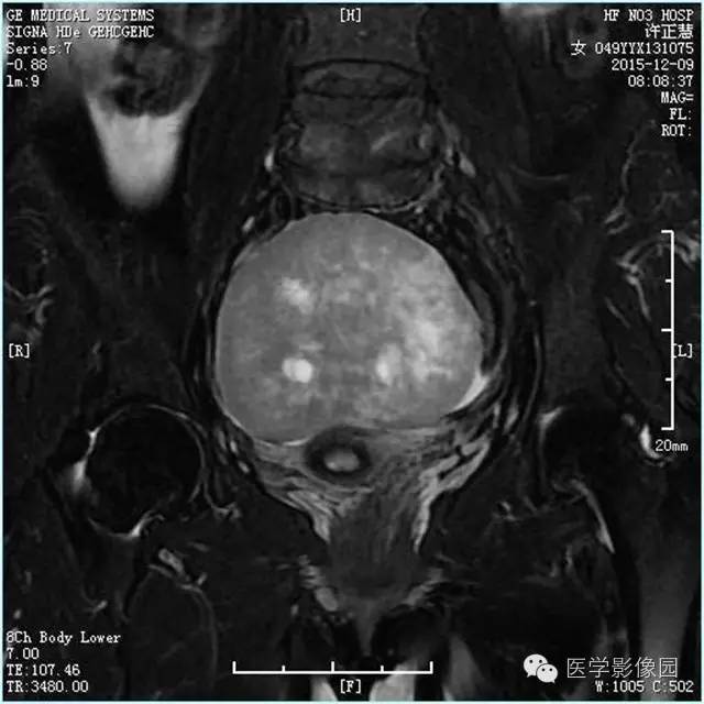 【病例】卵巢卵泡膜细胞瘤1例MR影像表现 【病例】卵巢卵泡膜细胞瘤1例MR影像表现