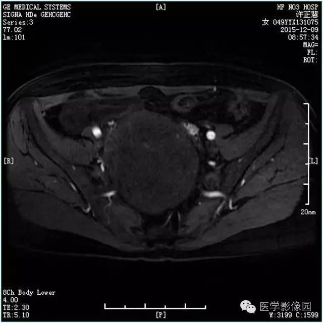 【病例】卵巢卵泡膜细胞瘤1例MR影像表现 【病例】卵巢卵泡膜细胞瘤1例MR影像表现