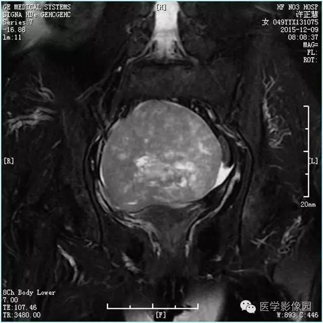 【病例】卵巢卵泡膜细胞瘤1例MR影像表现 【病例】卵巢卵泡膜细胞瘤1例MR影像表现