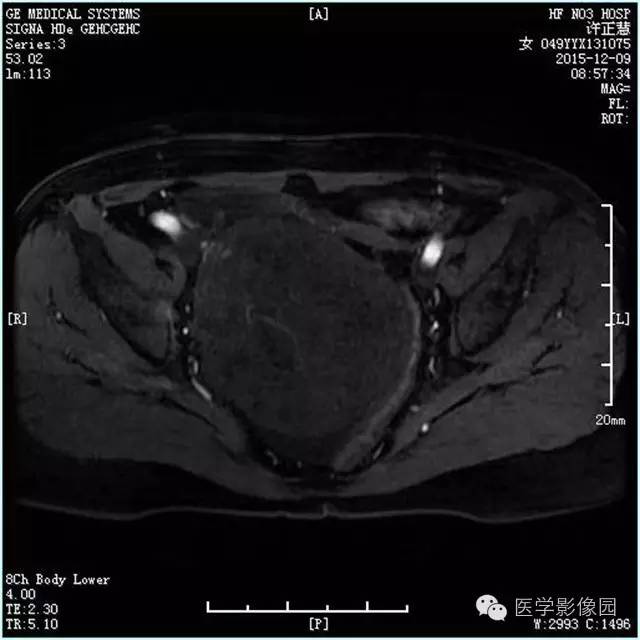 【病例】卵巢卵泡膜细胞瘤1例MR影像表现 【病例】卵巢卵泡膜细胞瘤1例MR影像表现