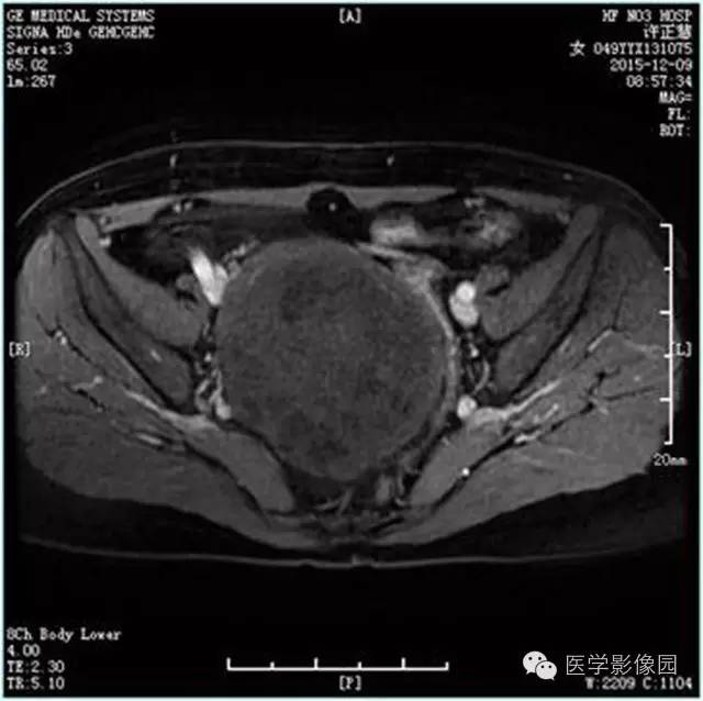 【病例】卵巢卵泡膜细胞瘤1例MR影像表现 【病例】卵巢卵泡膜细胞瘤1例MR影像表现