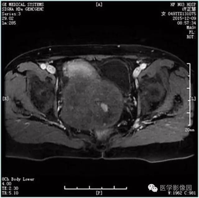【病例】卵巢卵泡膜细胞瘤1例MR影像表现 【病例】卵巢卵泡膜细胞瘤1例MR影像表现