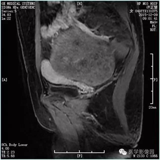 【病例】卵巢卵泡膜细胞瘤1例MR影像表现 【病例】卵巢卵泡膜细胞瘤1例MR影像表现