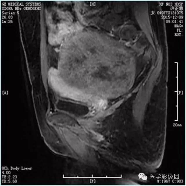 【病例】卵巢卵泡膜细胞瘤1例MR影像表现 【病例】卵巢卵泡膜细胞瘤1例MR影像表现