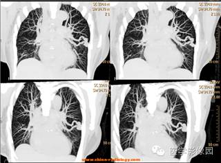 【病例】肺动静脉瘘1例CT影像表现 【病例】肺动静脉瘘1例CT影像表现
