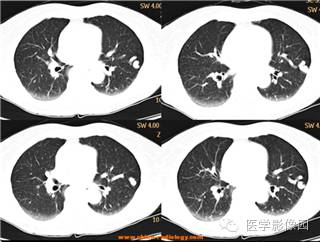 【病例】肺动静脉瘘1例CT影像表现 【病例】肺动静脉瘘1例CT影像表现
