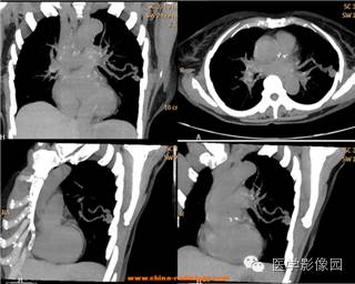【病例】肺动静脉瘘1例CT影像表现 【病例】肺动静脉瘘1例CT影像表现