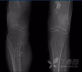 成软骨性肿瘤的影像诊断要点 成软骨性肿瘤的影像诊断要点