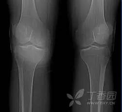 成软骨性肿瘤的影像诊断要点 成软骨性肿瘤的影像诊断要点