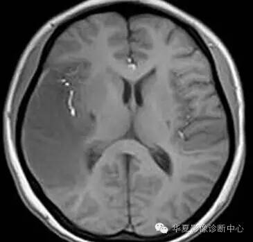【病例】线粒体脑肌病1例MR影像表现