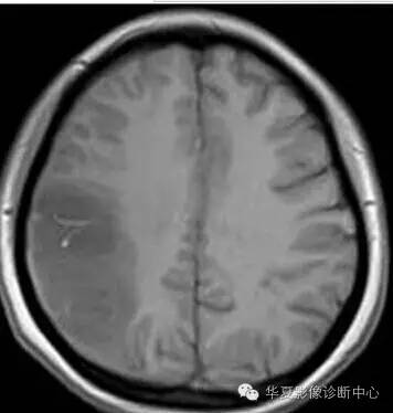 【病例】线粒体脑肌病1例MR影像表现 【病例】线粒体脑肌病1例MR影像表现