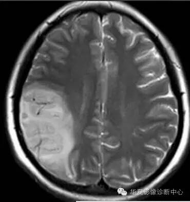 【病例】线粒体脑肌病1例MR影像表现 【病例】线粒体脑肌病1例MR影像表现