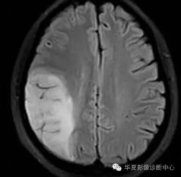 【病例】线粒体脑肌病1例MR影像表现 【病例】线粒体脑肌病1例MR影像表现