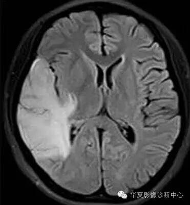 【病例】线粒体脑肌病1例MR影像表现 【病例】线粒体脑肌病1例MR影像表现