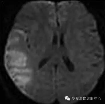 【病例】线粒体脑肌病1例MR影像表现 【病例】线粒体脑肌病1例MR影像表现