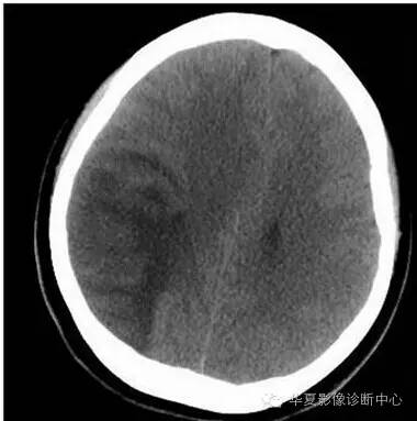 【病例】线粒体脑肌病1例MR影像表现 【病例】线粒体脑肌病1例MR影像表现