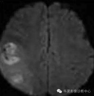 【病例】线粒体脑肌病1例MR影像表现 【病例】线粒体脑肌病1例MR影像表现