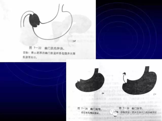 【PPT】婴幼儿消化道梗阻性疾病