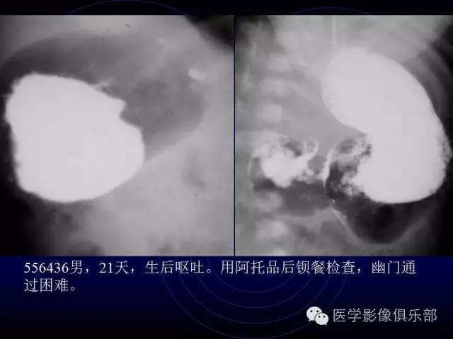 【PPT】婴幼儿消化道梗阻性疾病