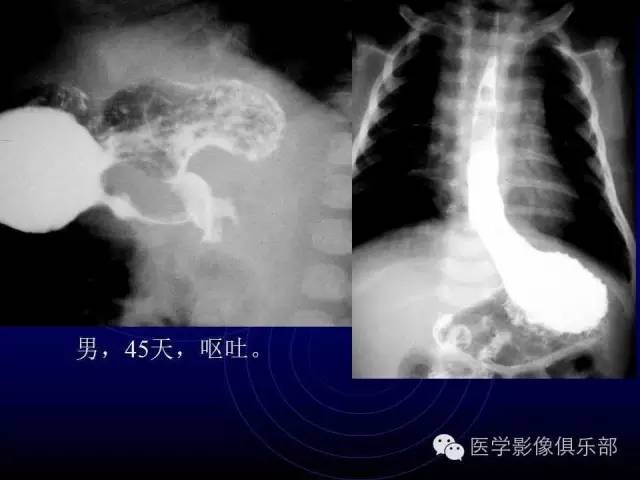 【PPT】婴幼儿消化道梗阻性疾病
